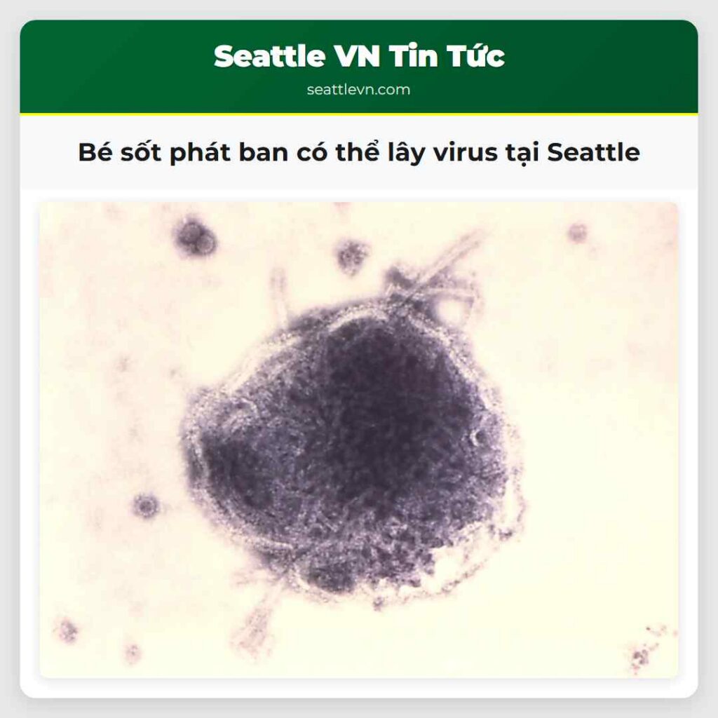 Bé sốt phát ban có thể lây virus tại Seattle